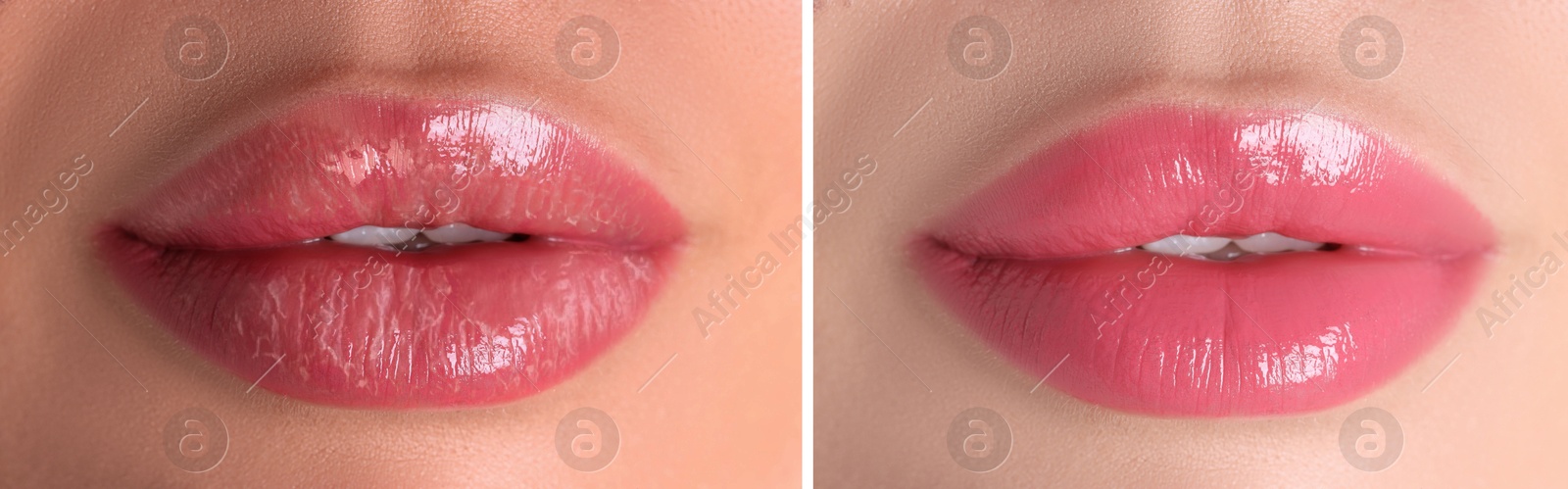 Image of Lip care. Woman with chapped and dry skin before and healthy skin after moisturizing treatment, collage