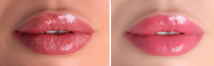Image of Lip care. Woman with chapped and dry skin before and healthy skin after moisturizing treatment, collage