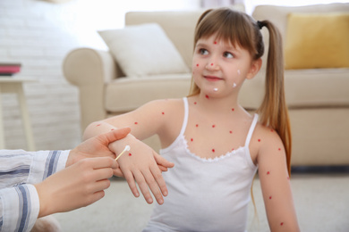 Woman applying cream onto skin of little girl with chickenpox at home