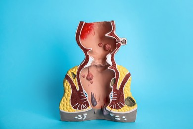Photo of Model of unhealthy lower rectum with inflamed vascular structures on light blue background. Hemorrhoid problem