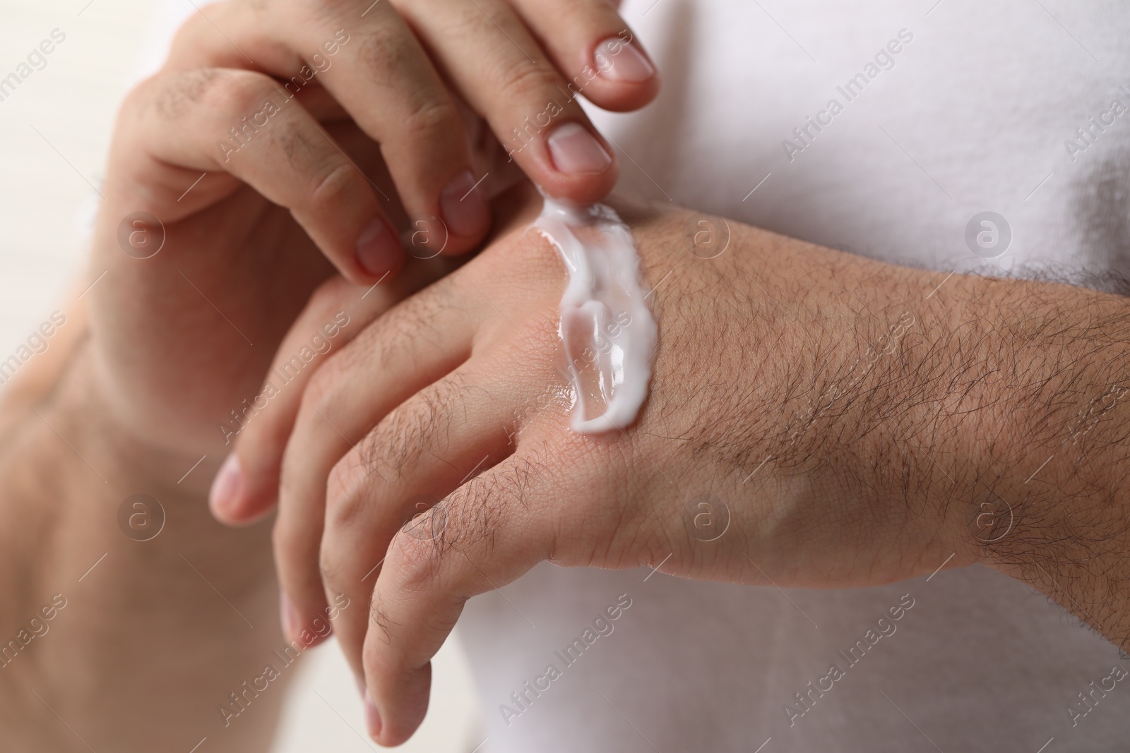 Photo of Man with dry skin applying cream onto his hand, closeup