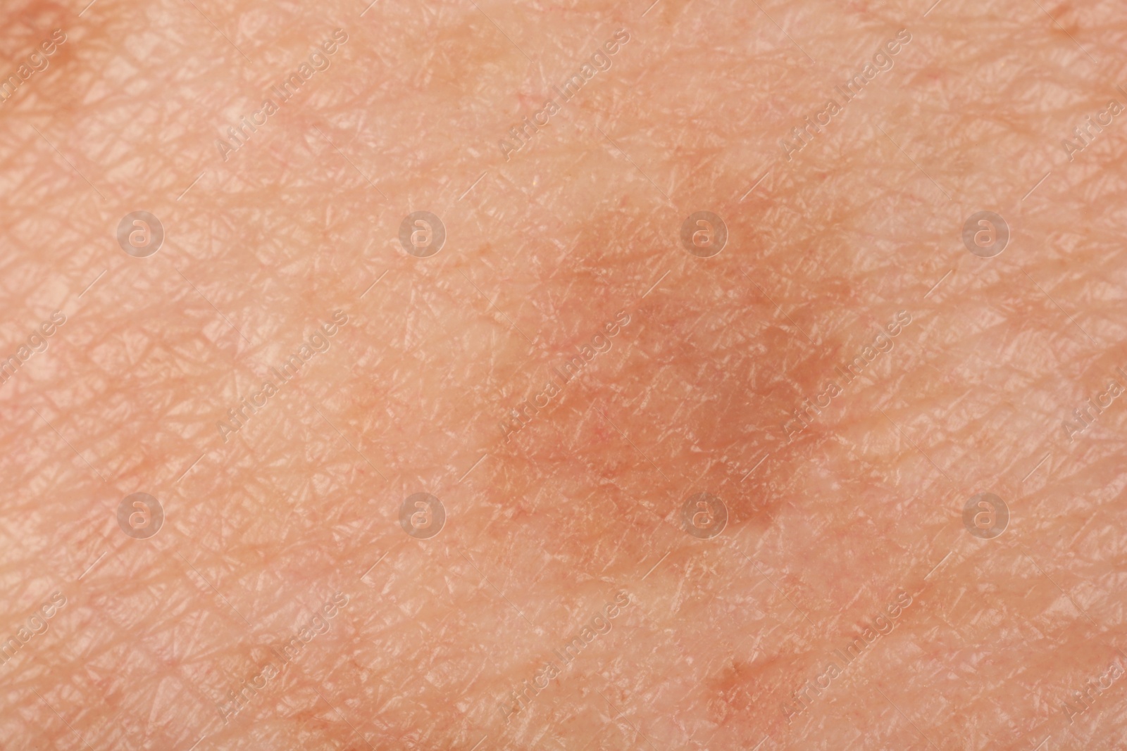 Photo of Texture of skin with pigmentation as background, macro view