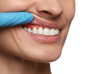 Doctor examining woman's inflamed gum on white background, closeup