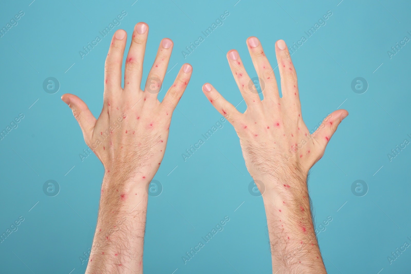 Photo of Man with rash suffering from monkeypox virus on light blue background, closeup