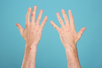 Photo of Man with rash suffering from monkeypox virus on light blue background, closeup