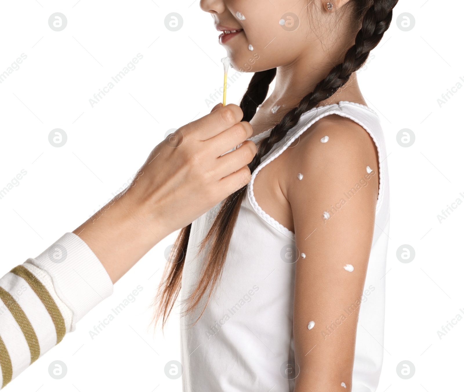 Photo of Mother applying cream onto skin of her daughter with chickenpox against white background, closeup