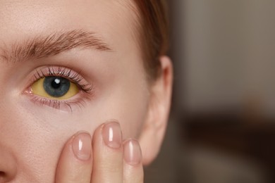 Photo of Woman with yellow eyes on blurred background, closeup. Symptom of hepatitis