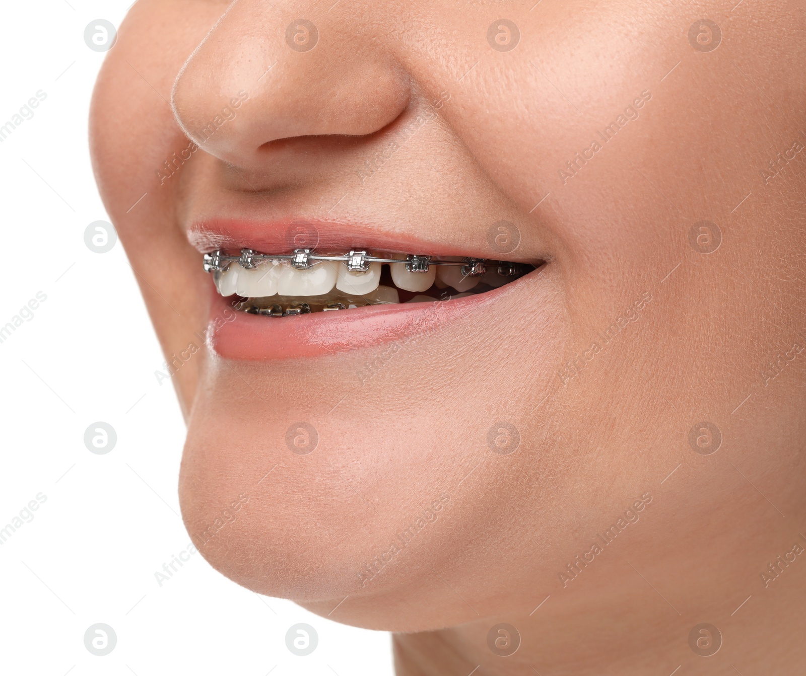 Photo of Smiling woman with dental braces on white background, closeup