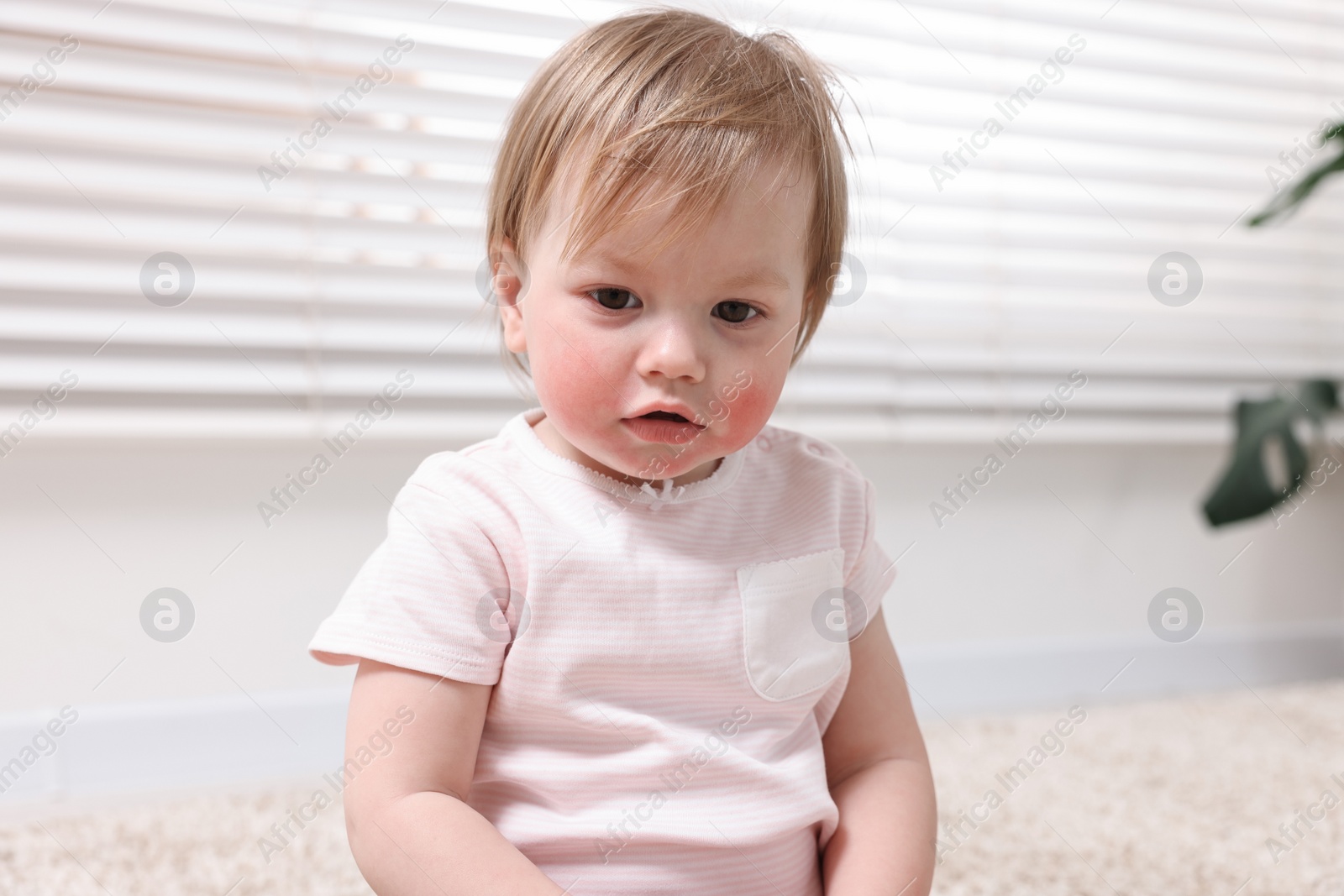 Photo of Portrait of little girl with diathesis symptom on cheeks indoors