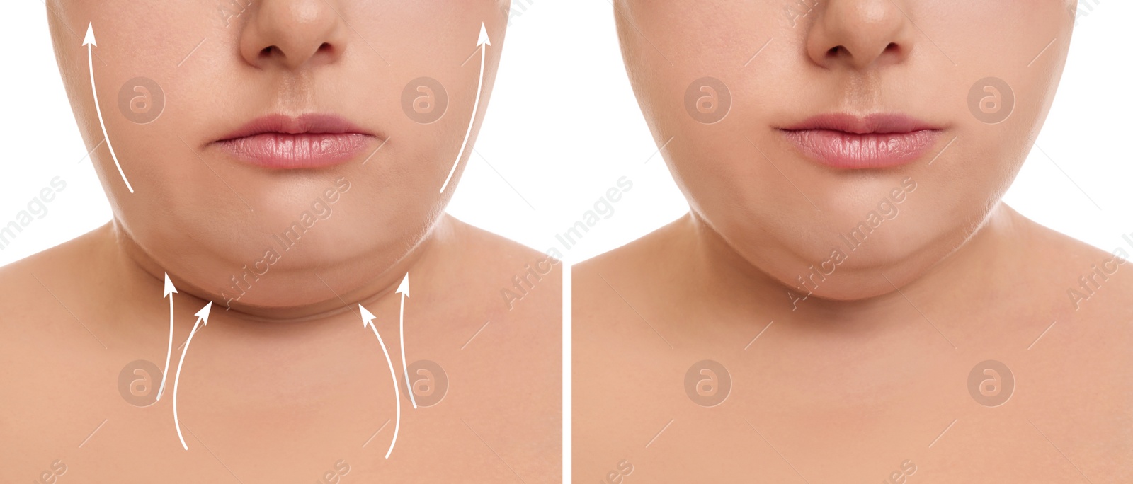 Image of Woman before and after plastic surgery operation on white background, closeup. Double chin problem 