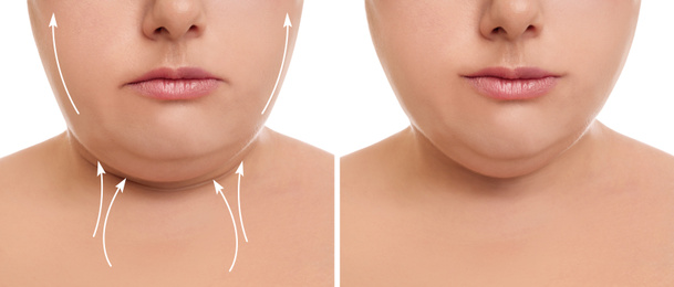 Image of Woman before and after plastic surgery operation on white background, closeup. Double chin problem 