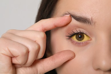 Photo of Woman with yellow eyes on light background, closeup. Symptom of hepatitis