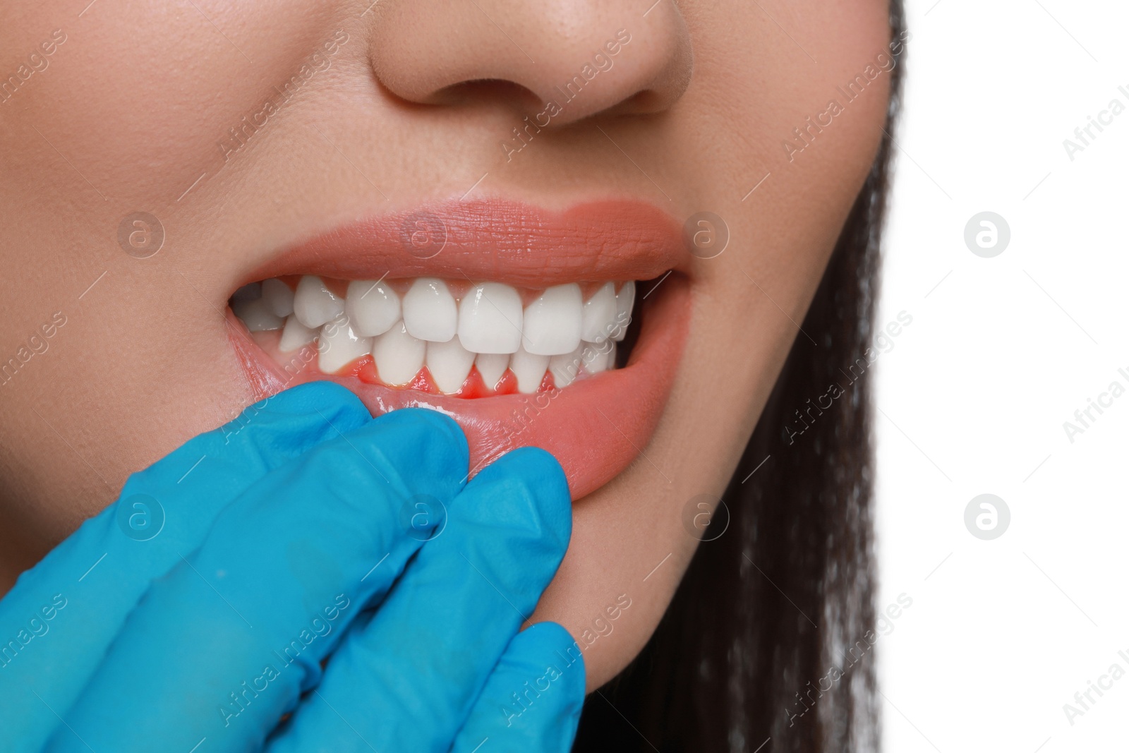 Image of Doctor examining woman's inflamed gum on white background, closeup