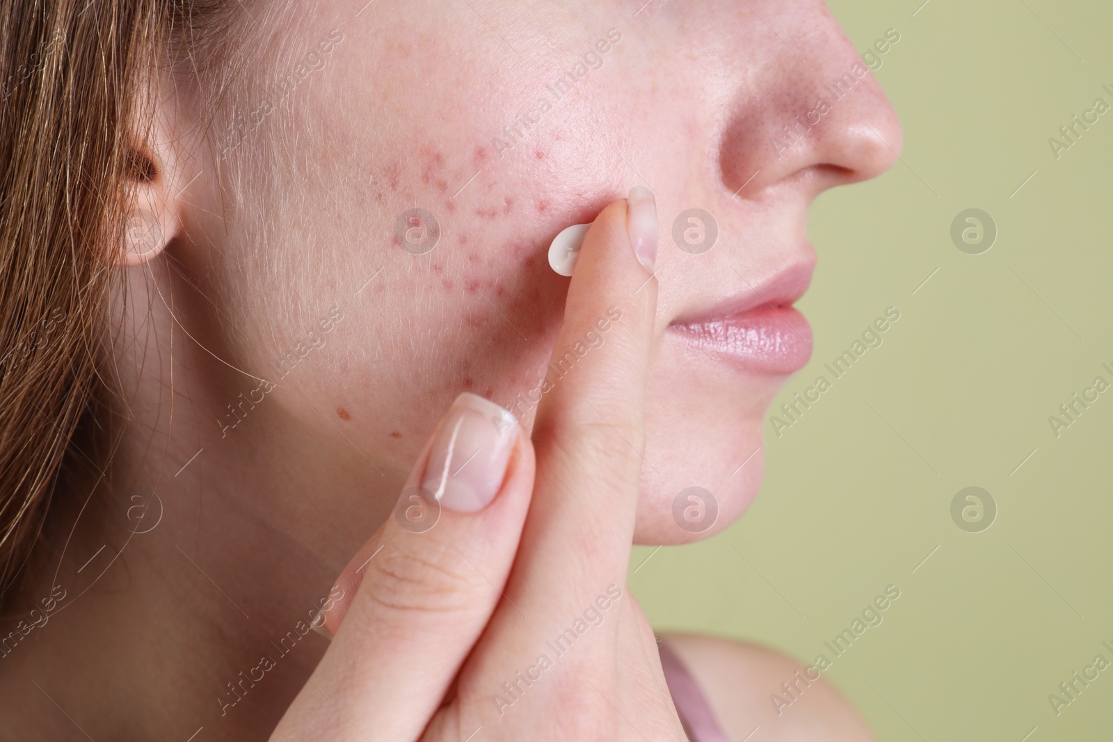 Photo of Young woman with acne problem applying cosmetic product onto her skin on olive background, closeup