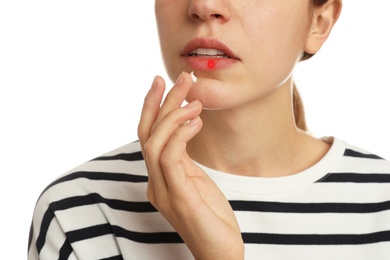 Woman with herpes applying cream onto lip on white background, closeup