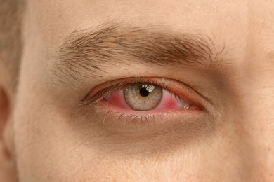 Image of Man suffering from conjunctivitis, closeup of red eye