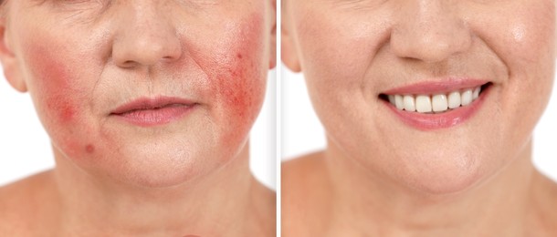 Image of Before and after rosacea treatment. Photoswoman on white background, closeup. Collage showing affected and healthy skin