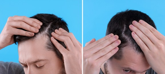 Image of Man showing hair before and after dandruff treatment on light blue background, collage