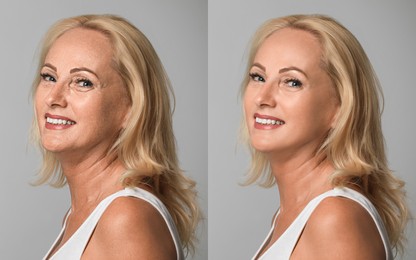 Beautiful mature woman before and after cosmetic procedure on light grey background, collage. Plastic surgery