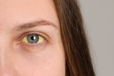 Photo of Woman with yellow eyes on light background, closeup. Symptom of hepatitis