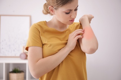 Photo of Young woman scratching forearm indoors. Allergy symptoms