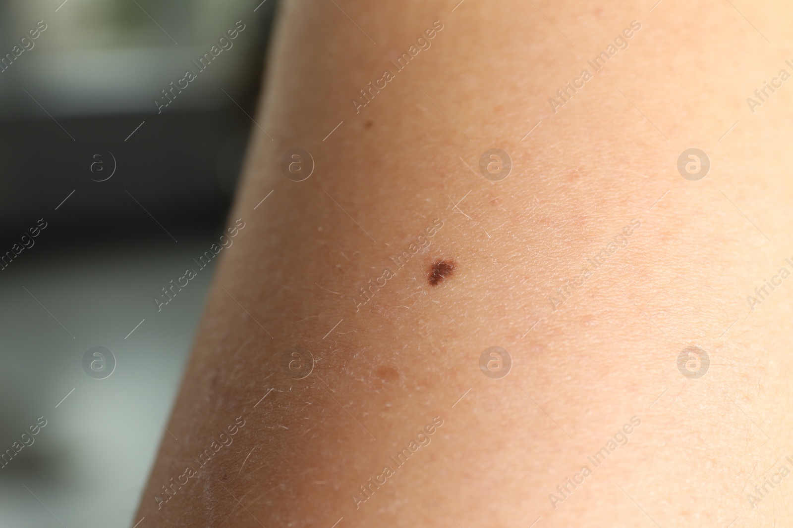 Photo of Closeup view of woman's body with birthmark