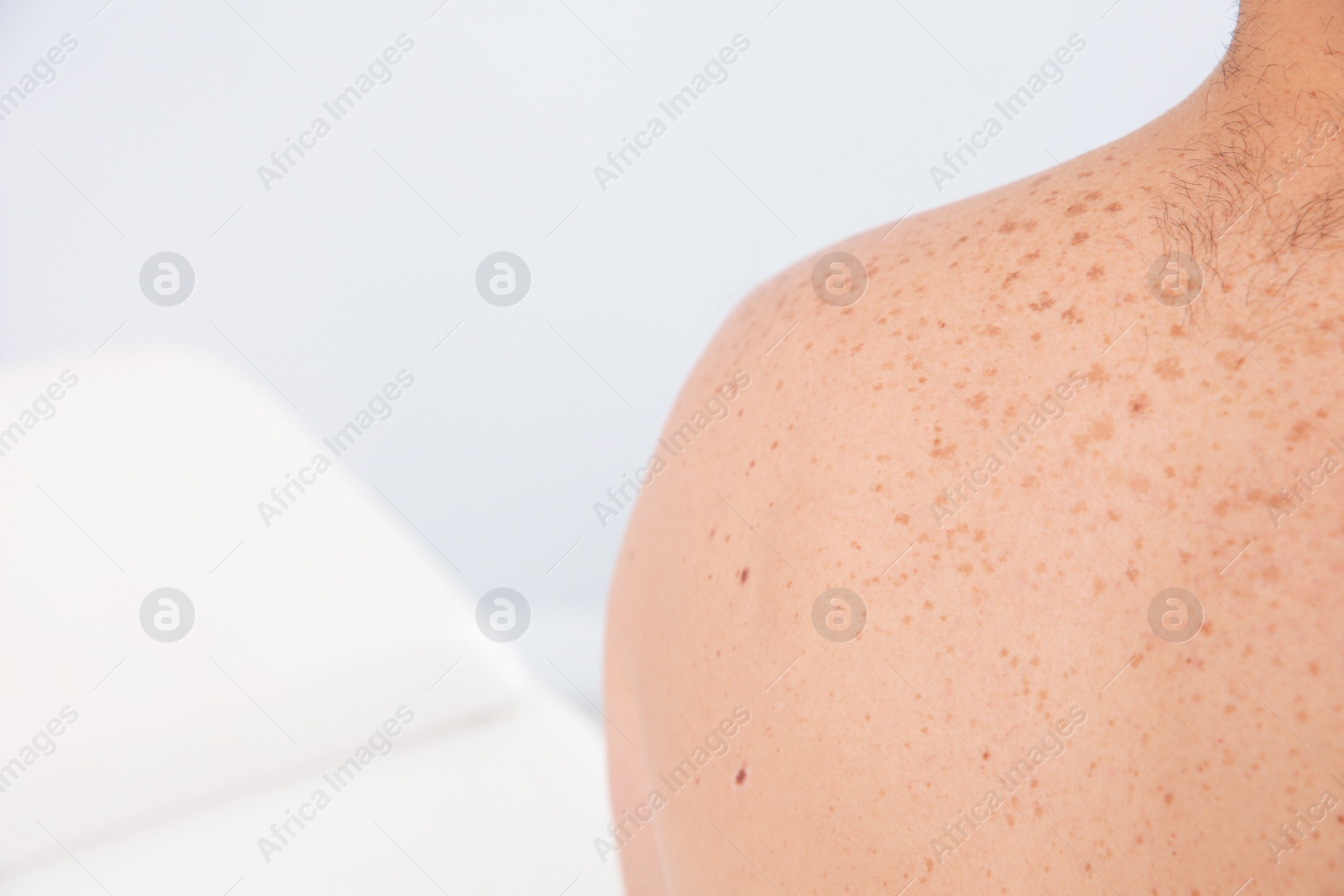 Photo of Man with birthmarks in clinic, closeup. Visit to dermatologist