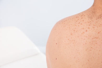 Photo of Man with birthmarks in clinic, closeup. Visit to dermatologist