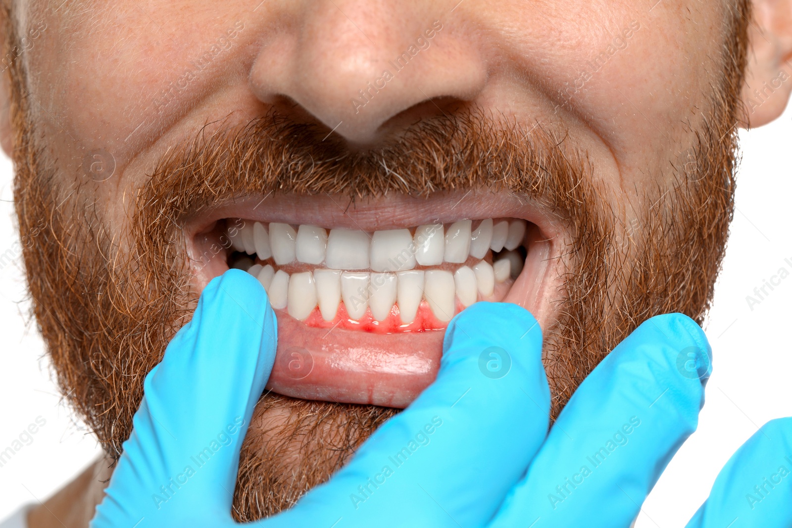 Image of Doctor examining man's inflamed gum on white background, closeup