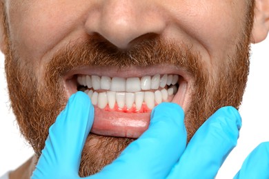 Doctor examining man's inflamed gum on white background, closeup