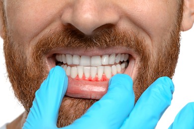 Image of Doctor examining man's inflamed gum on white background, closeup