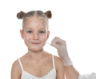 Doctor applying cream onto skin of little girl with chickenpox against white background. Varicella zoster virus
