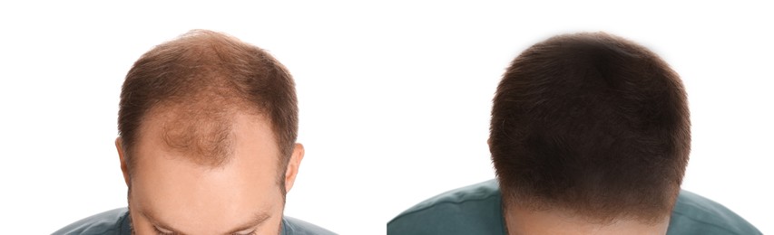 Man before and after hair treatment with high frequency darsonval device on white background, closeup. Collage of photos