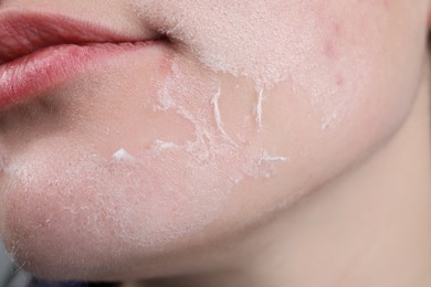 Photo of Woman with dry skin on face, closeup