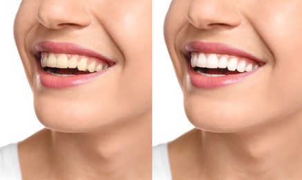 Image of Collage with photos of woman before and after teeth whitening, closeup