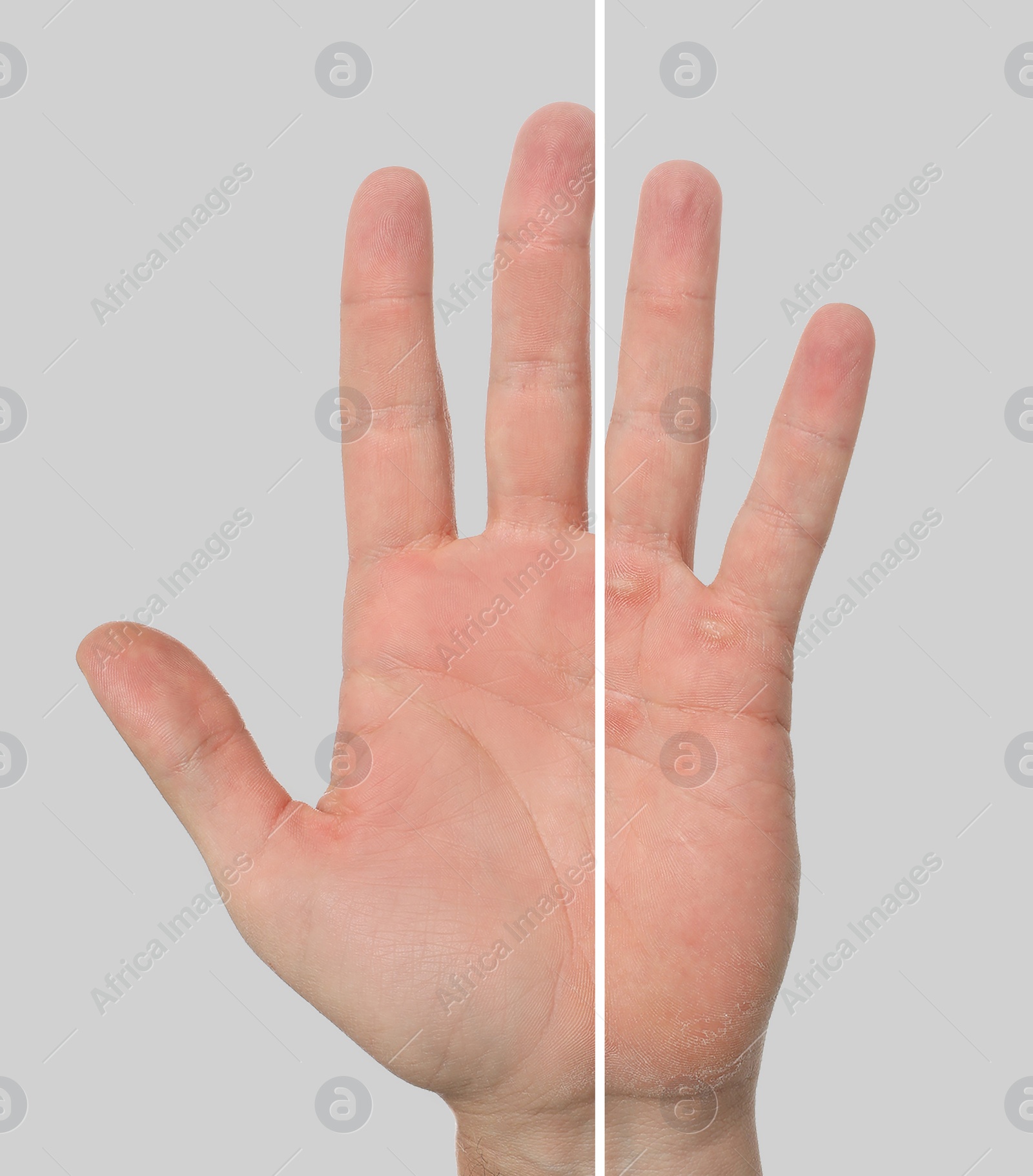 Image of Man showing hand without and with calluses on light grey background., closeup. Collage 