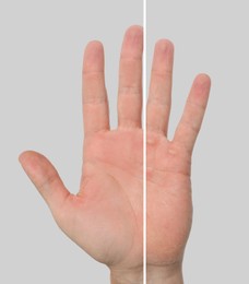 Image of Man showing hand without and with calluses on light grey background., closeup. Collage 