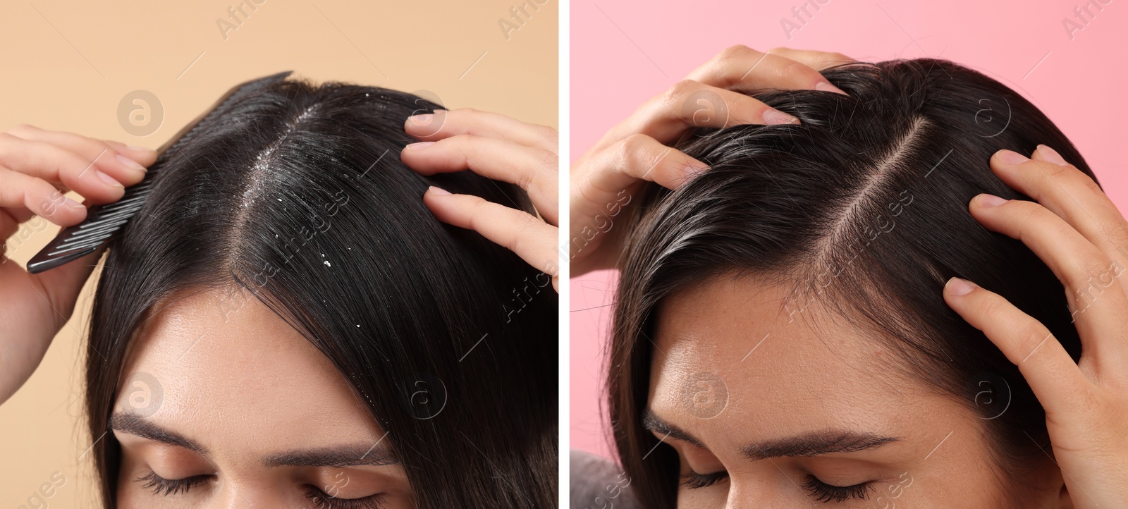 Image of Woman showing hair before and after dandruff treatment on color backgrounds, collage