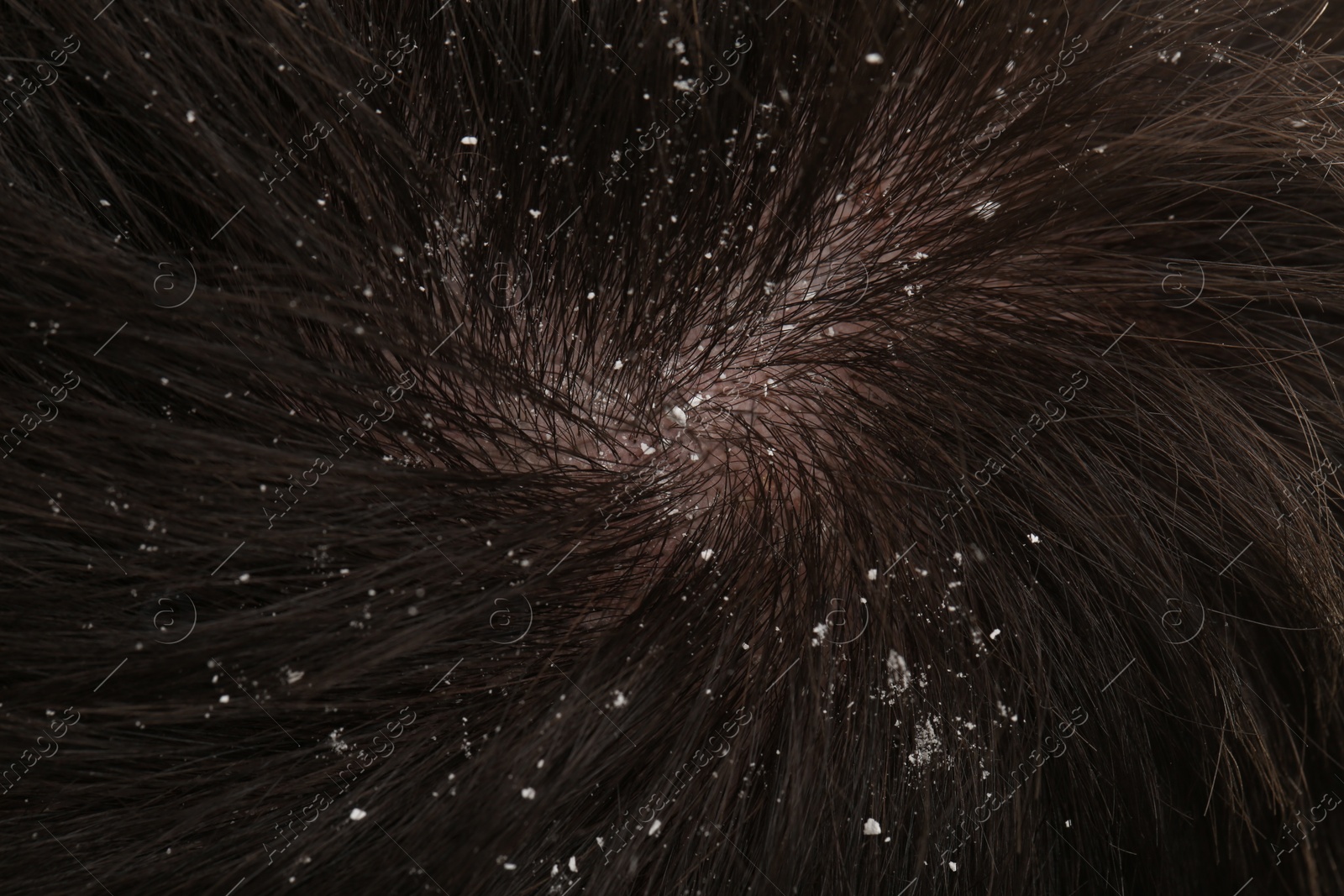 Photo of Man with dandruff in his dark hair, closeup