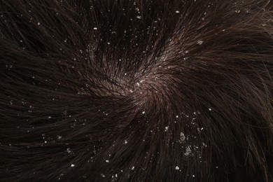 Photo of Man with dandruff in his dark hair, closeup