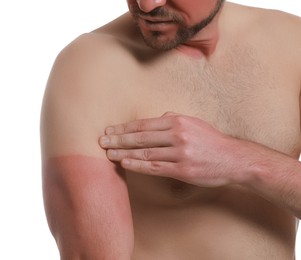 Photo of Man with sunburned skin on white background, closeup