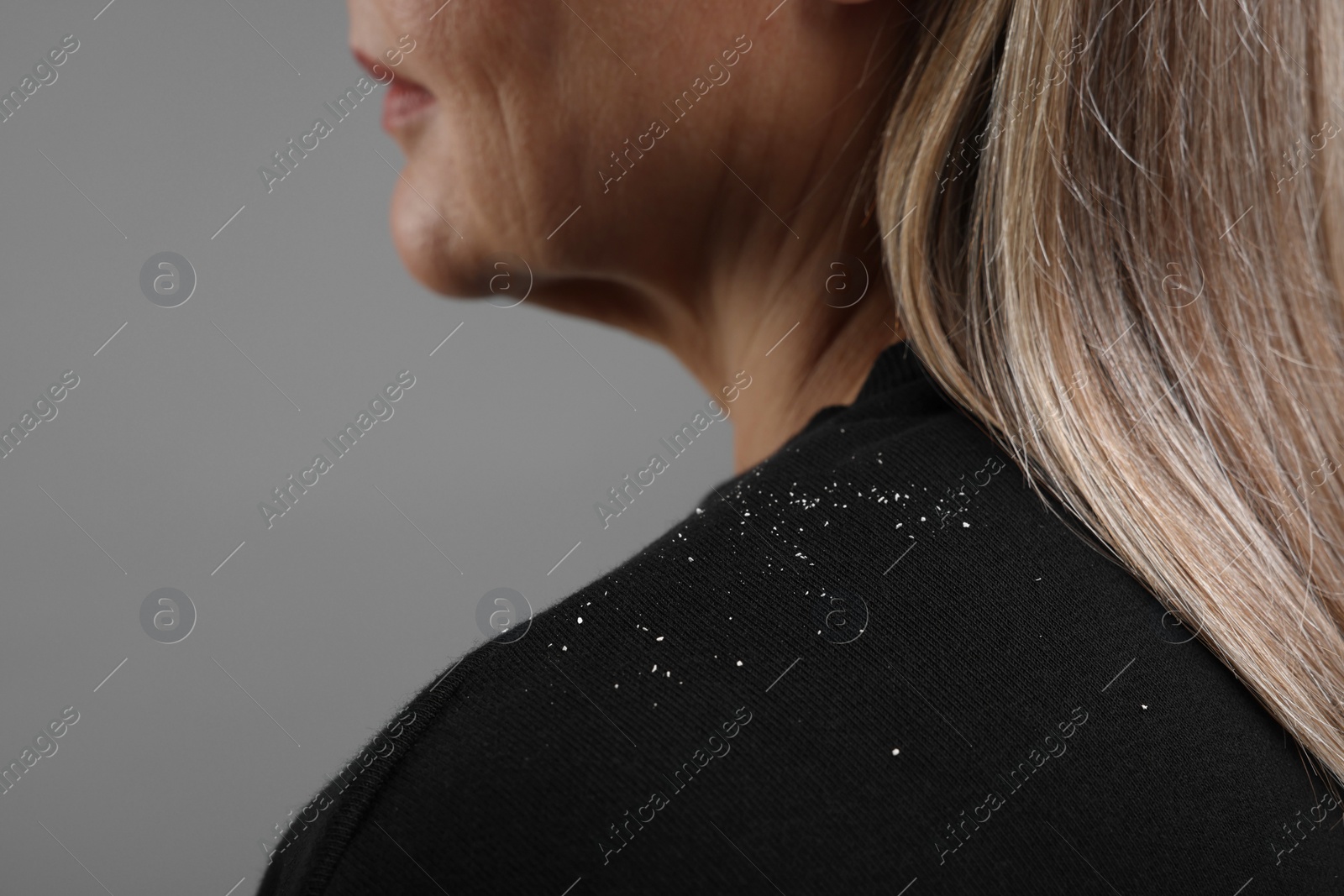 Photo of Woman with dandruff on her sweater against gray background, closeup