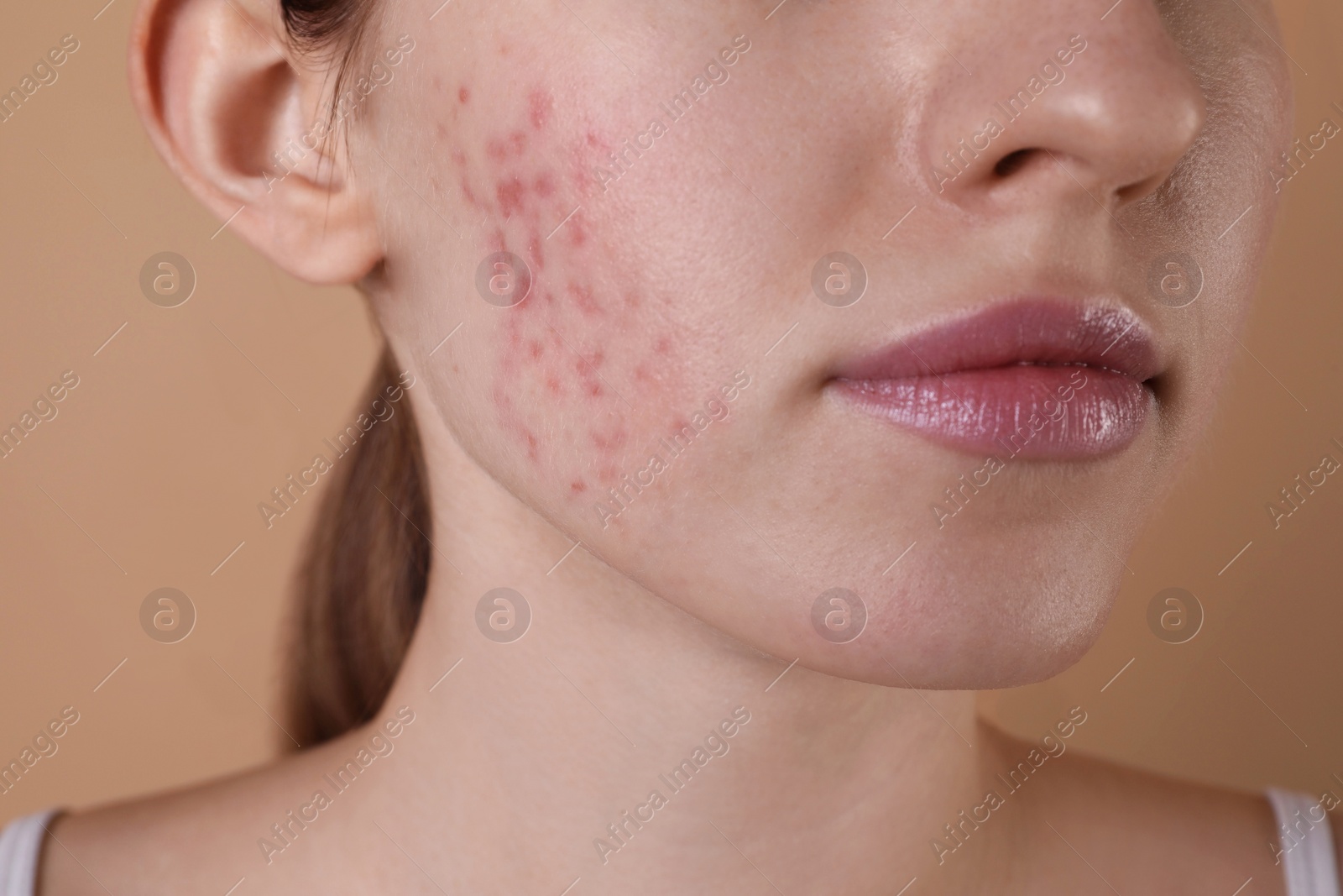 Photo of Young woman with acne problem on beige background, closeup