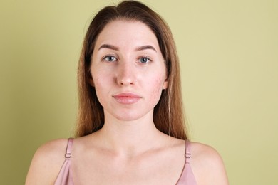 Young woman with acne problem on olive background