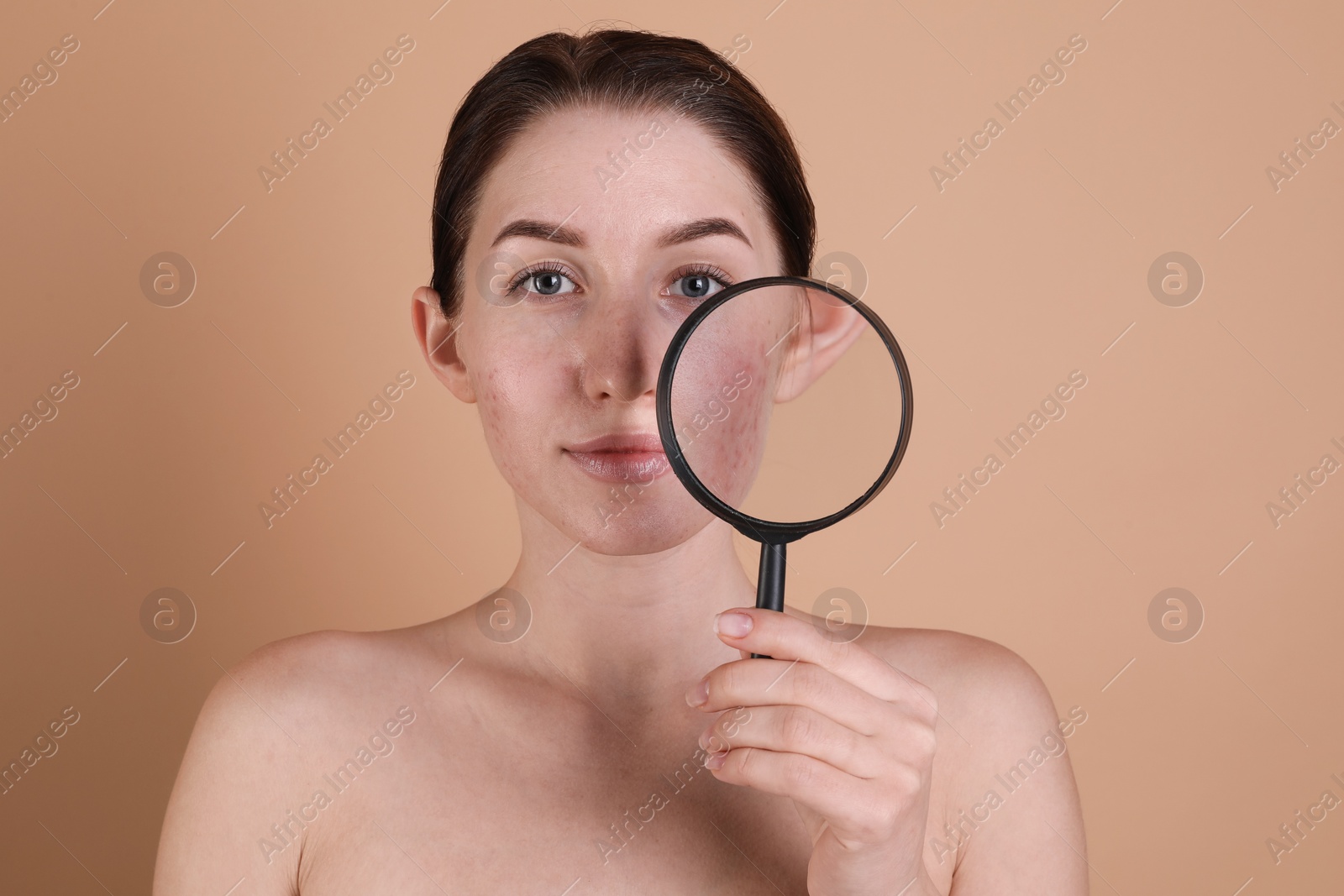 Photo of Young woman with acne problem holding magnifying glass near her skin on beige background