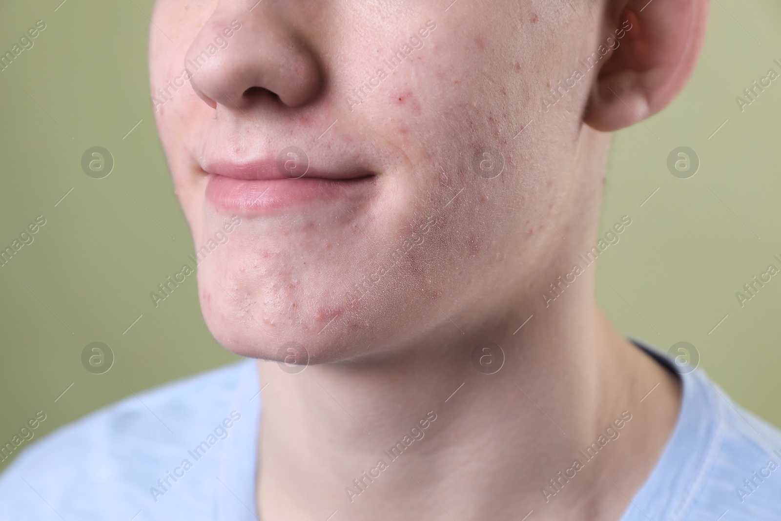 Photo of Young man with acne problem on olive background, closeup