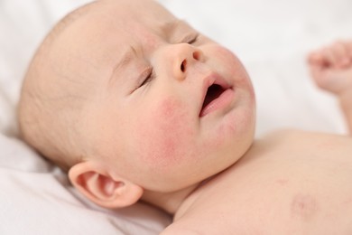 Photo of Cute little baby with allergic redness on cheeks lying on white blanket, closeup