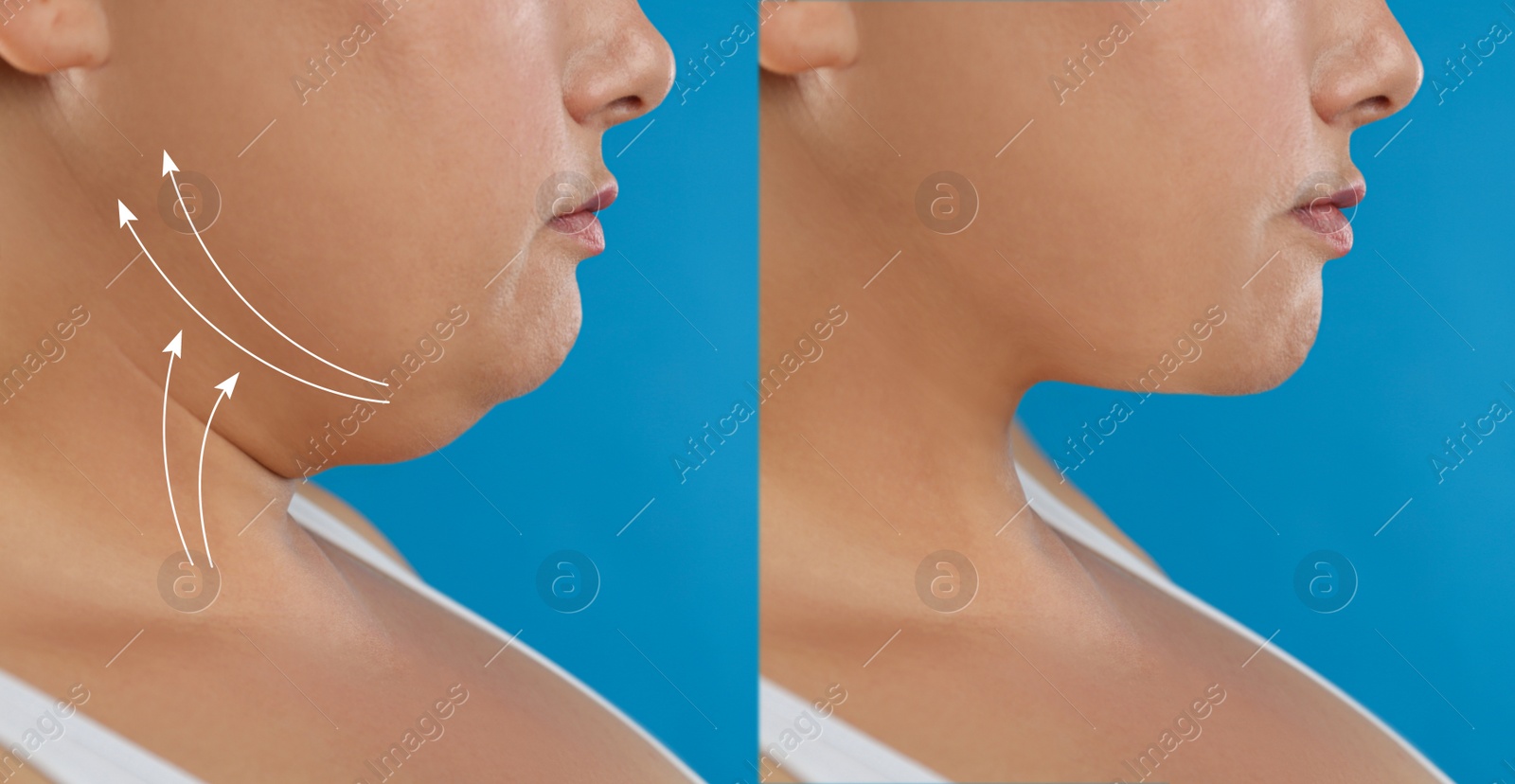 Image of Woman before and after plastic surgery operation on blue background, closeup. Double chin problem 