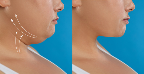 Image of Woman before and after plastic surgery operation on blue background, closeup. Double chin problem 