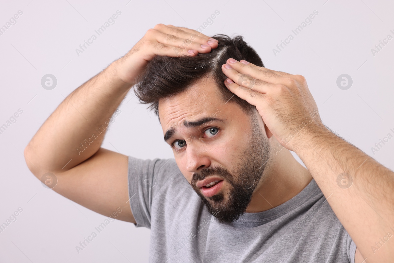 Photo of Emotional man with dandruff in his dark hair on light grey background